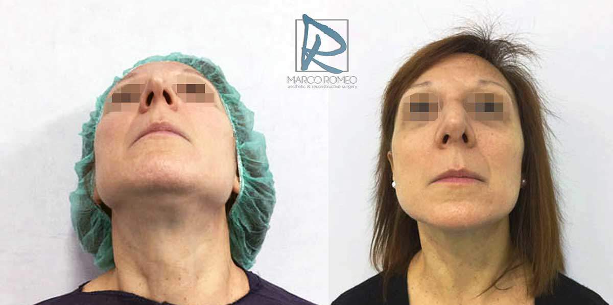Rhinoplasty Clinic Case 83000 - From below - Dr Marco Romeo