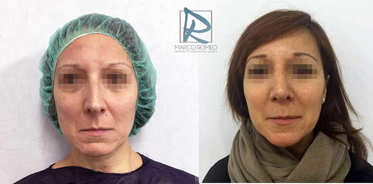 Rhinoplasty Clinic Case 83000 - Front - Dr Marco Romeo