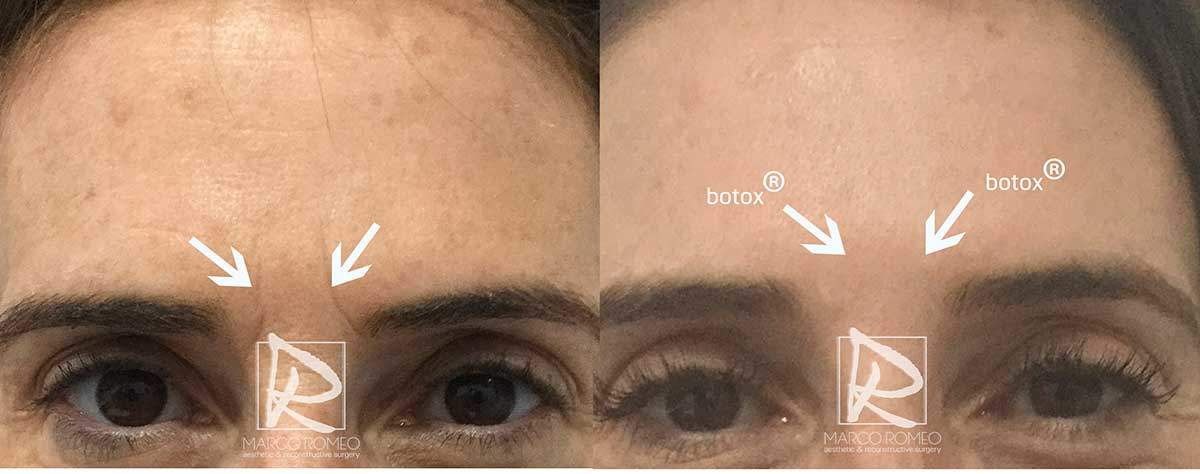 Botox Front - Dr Marco Romeo