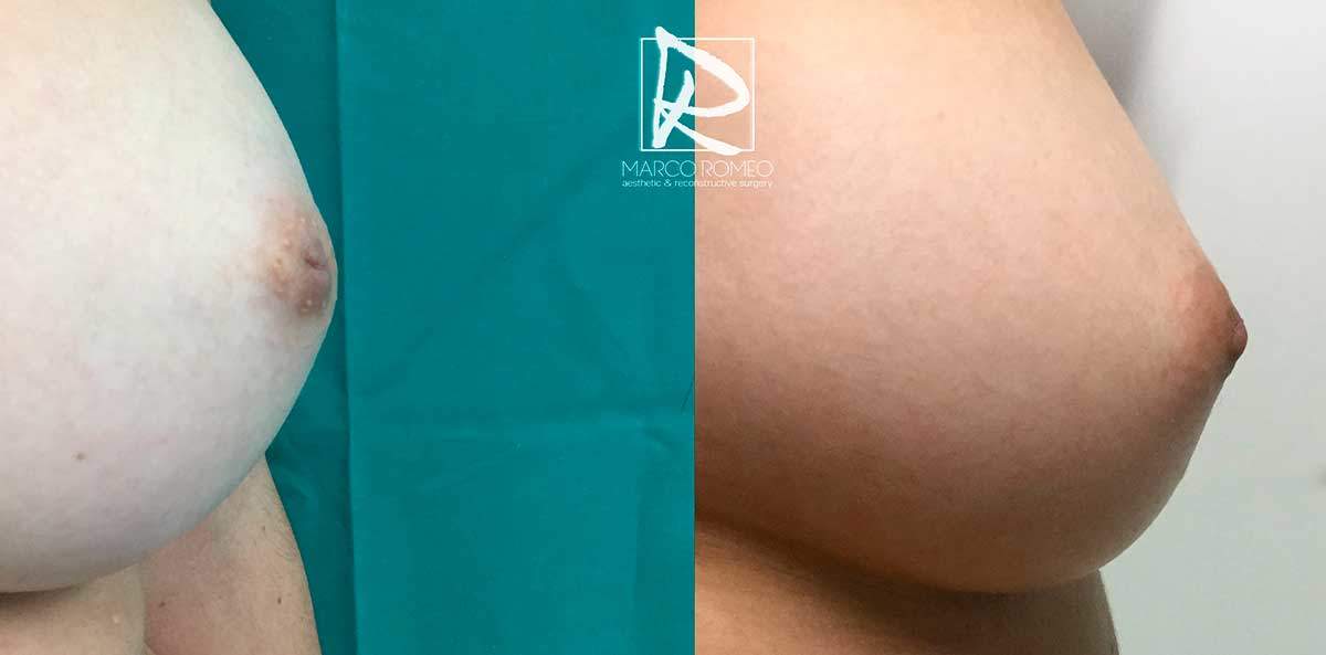 Inverted Nipple Left - Dr Marco Romeo
