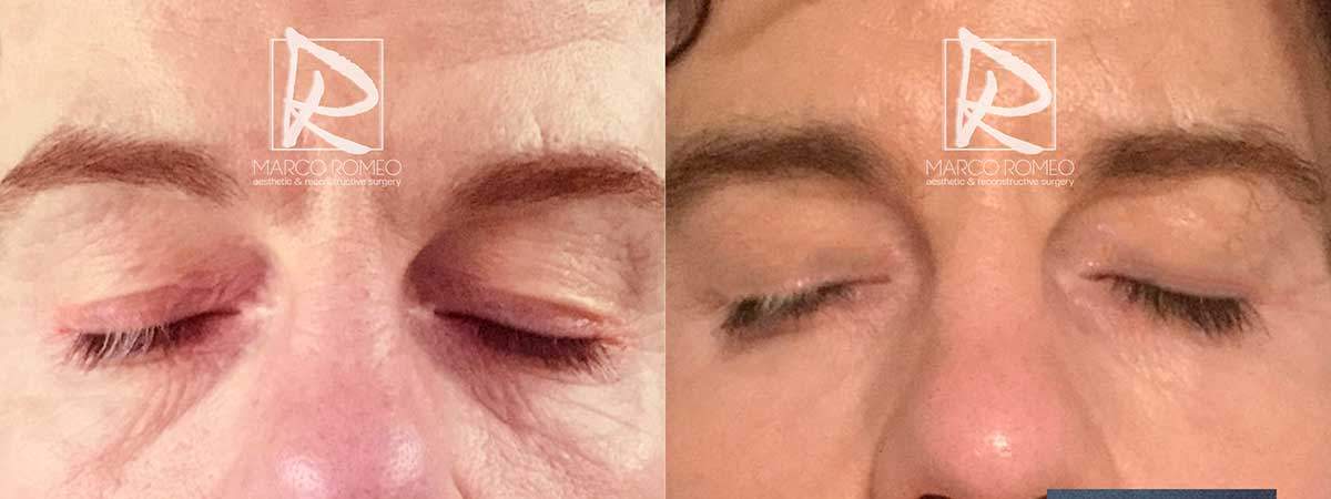 Upper Eyelid Surgery & Unilateral Congenital Ptosis - Closed eyes - Dr Marco Romeo