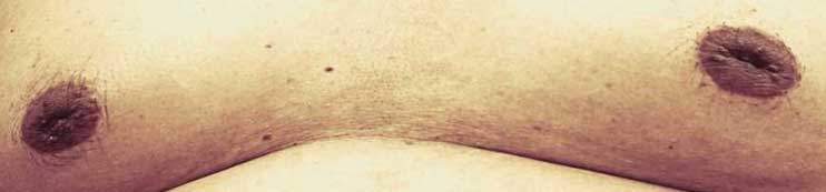 • Ilustración de aumento de mama masculina (Ginecomastia)