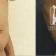 Abdominoplastia-70000-Barriga-Ángulo-Derecho---Dr-Marco-Romeo