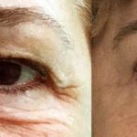 Blefaroplastia - Antes y Después - Frente Ojos Abiertos - Dr Marco Romeo