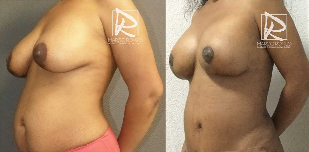 Mommy Makeover - Before and After - Left Angle - Dr Marco Romeo