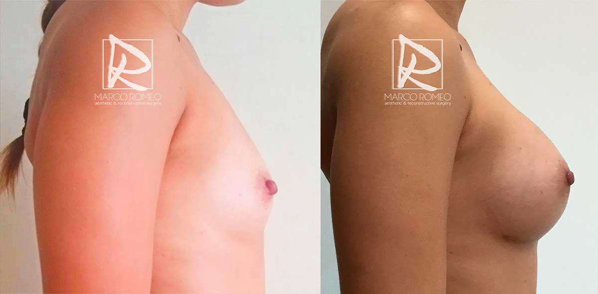 Aumento de mamario lado derecho - Dr Marco Romeo