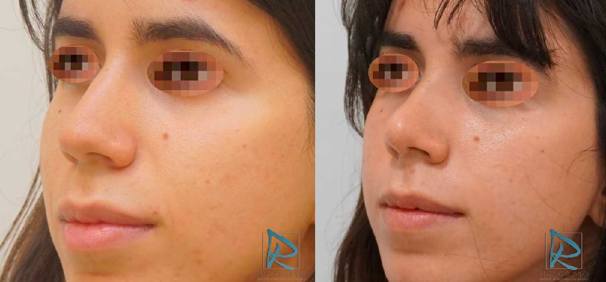 Rinoplastia Ultrasónica - Antes y Después - Ángulo izquierdo - Dr Marco Romeo