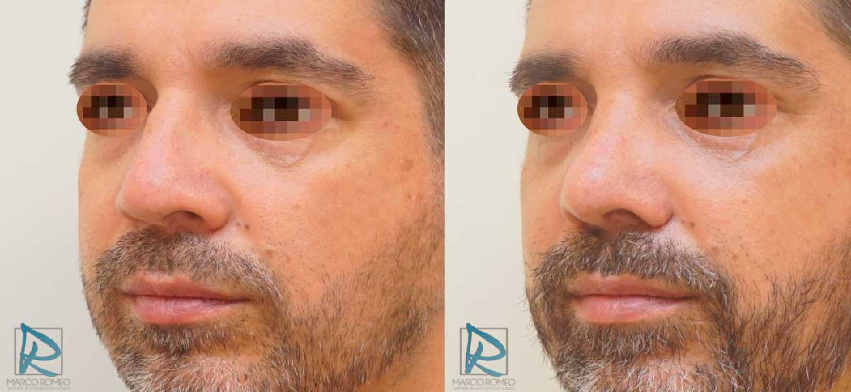 Rinoseptoplastia Ultrasónica - Antes y Después - Ángulo Izquierdo - Dr Marco Romeo