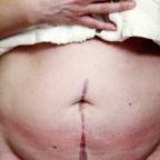 Tratamiento de Cicatrices - Dr Marco Romeo