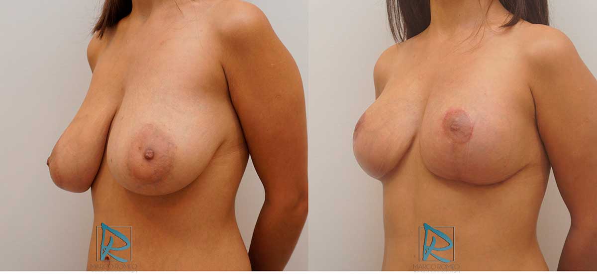Reducción de Mamas Ángulo izquierdo - Fotos Antes y Después - Dr Marco Romeo 10300