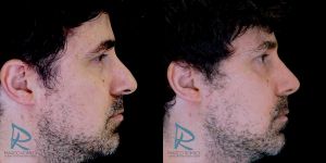 Rinoplastia-Ultrasónica---Fotos-Antes-y-Después---Lado-derecho
