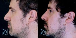 Rinoplastia-Ultras&oacute;nica---Fotos-Antes-y-Despu&eacute;s---Lado-izquierdo