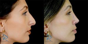 Rinoplastia Ultrasónica Primaria Fotos Antes y Después Lado derecho AFI170225 Dr Marco Romeo