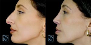 Rinoplastia Ultras&oacute;nica Primaria Fotos Antes y Despu&eacute;s Lado izquierdo AFI170225 Dr Marco Romeo