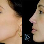 Rinoplastia Ultrasónica Primaria Fotos Antes y Después Lado izquierdo AFI170225 Dr Marco Romeo