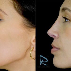 Rinoplastia Ultrasónica Primaria Fotos Antes y Después Lado izquierdo AFI170225 Dr Marco Romeo