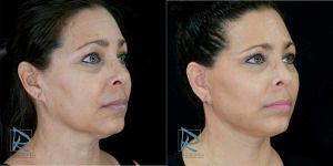 Lifting Facial &ndash; Fotos Antes y Despu&eacute;s &ndash; &Aacute;ngulo derecho ODDP24225 &ndash; Dr Marco Romeo