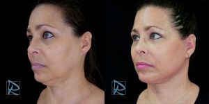 Lifting Facial &ndash; Fotos Antes y Despu&eacute;s &ndash; &Aacute;ngulo izquierdo ODDP24225 &ndash; Dr Marco Romeo