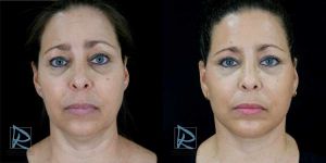Lifting Facial &ndash; Fotos Antes y Despu&eacute;s &ndash; Frente ODDP24225 &ndash; Dr Marco Romeo