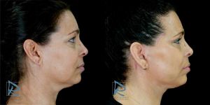 Lifting Facial &ndash; Fotos Antes y Despu&eacute;s &ndash; Lado derecho ODDP24225 &ndash; Dr Marco Romeo