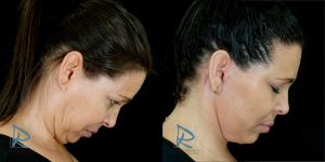 Lifting Facial &ndash; Fotos Antes y Despu&eacute;s &ndash; Lado derecho inclinada ODDP24225 &ndash; Dr Marco Romeo